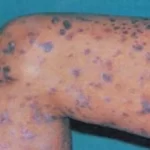 Lichen Planus Ayurvedic Treatment