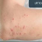 Urticaria Ayurvedic Treatment