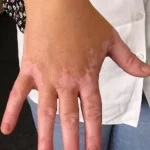 Vitiligo Ayurvedic Treatment