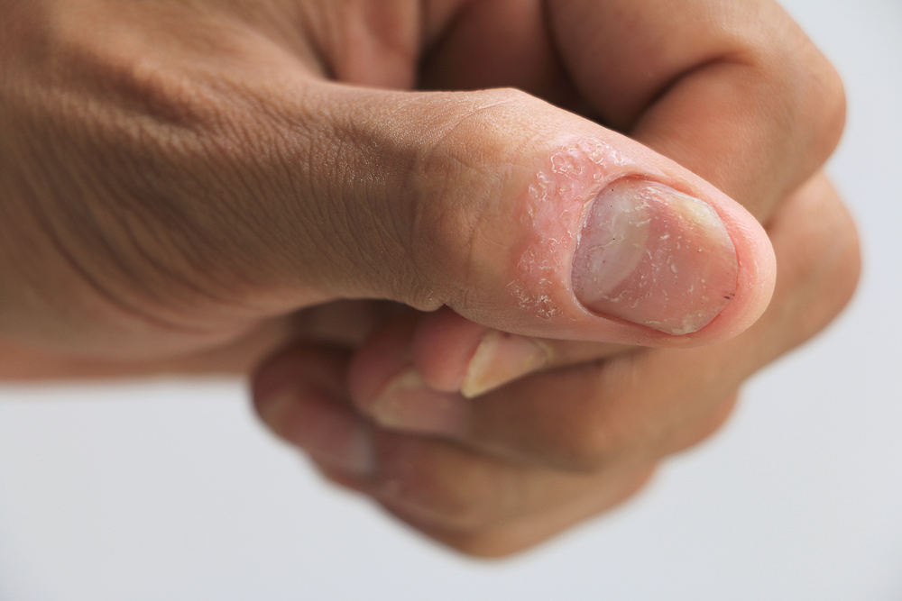 Psoriasis Nails vs. Fungus: Pictures and Differences to Look For - GoodRx