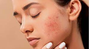 Acne & Pimple Ayurvedic Treatment