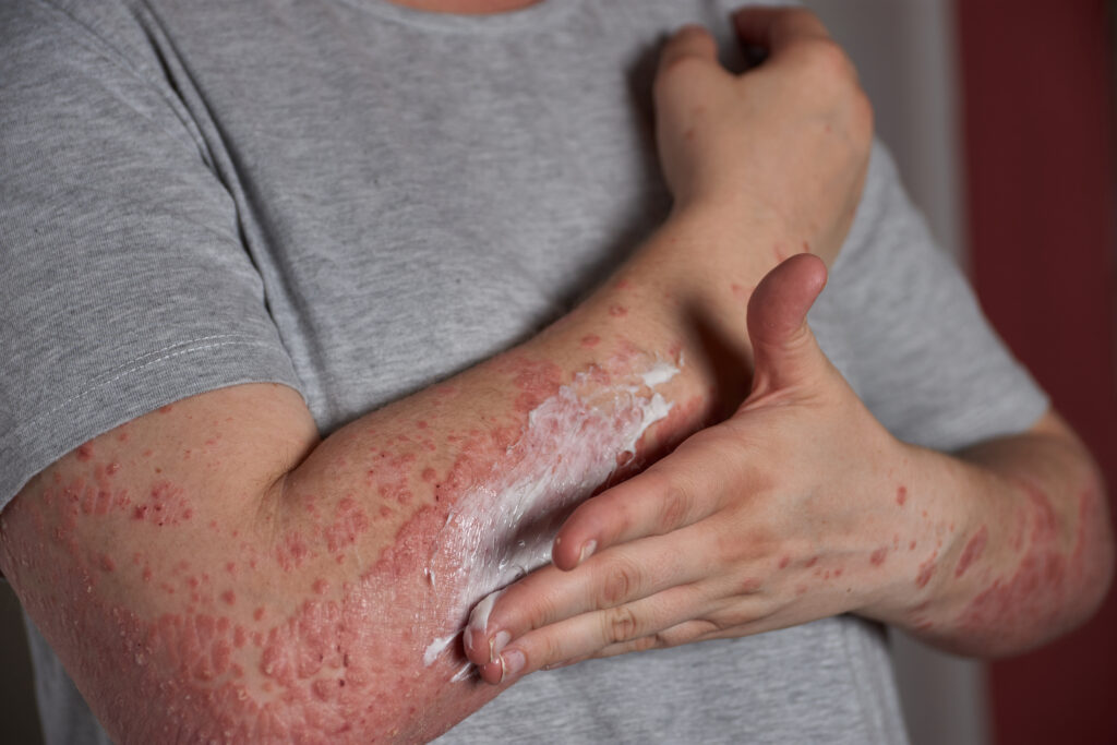 What Are The Causes And Symptoms Of Psoriasis?