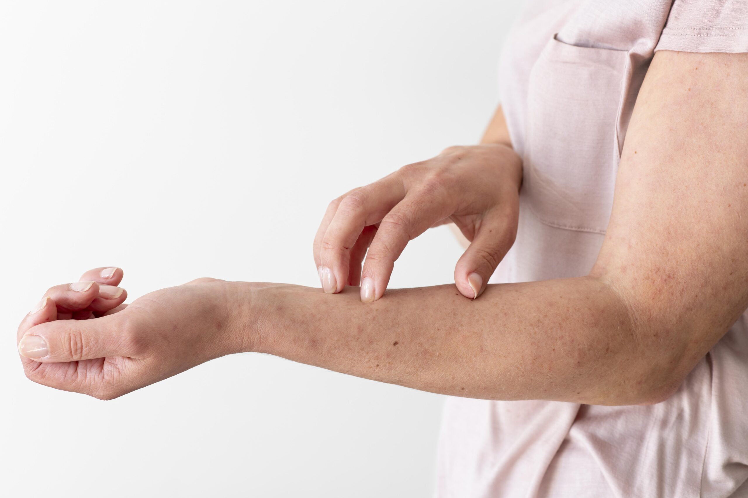 How To Prevent Psoriasis Symptoms Naturally?