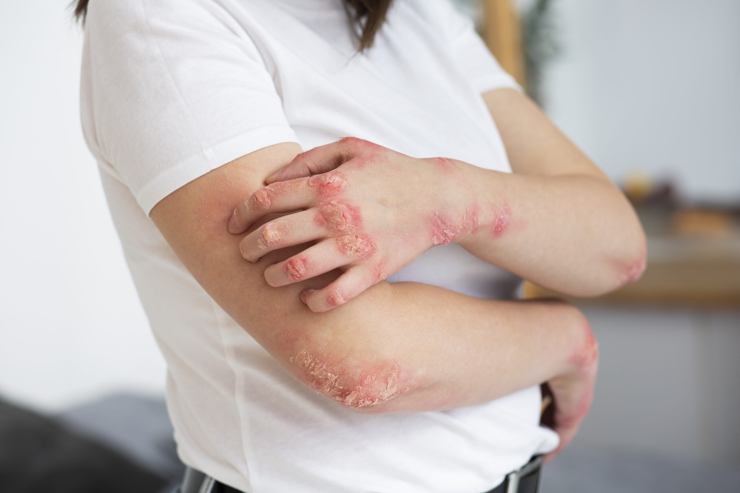 Benefits of Tracking Your Psoriasis Symptoms - Heal Psoriasis