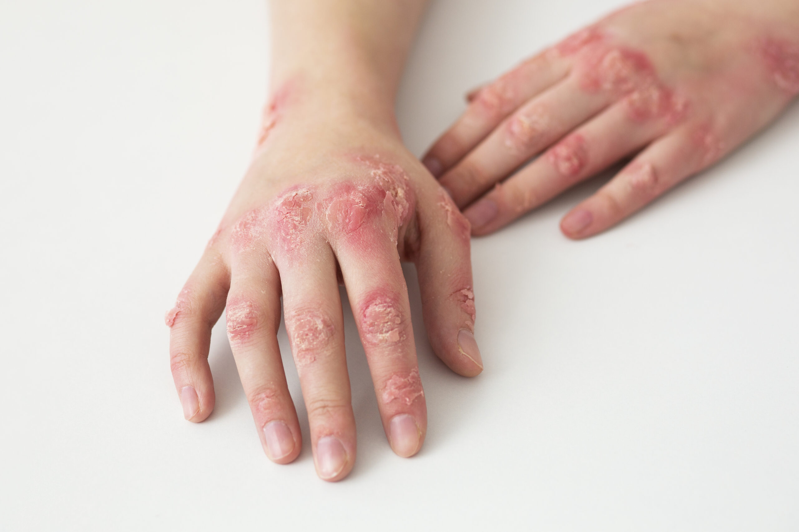 4 Things You Didn’t Realize Were Affected by Psoriasis
