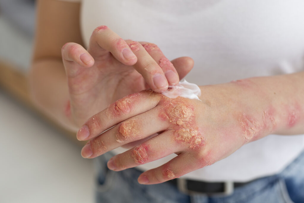 Prevent Psoriasis From Spreading
