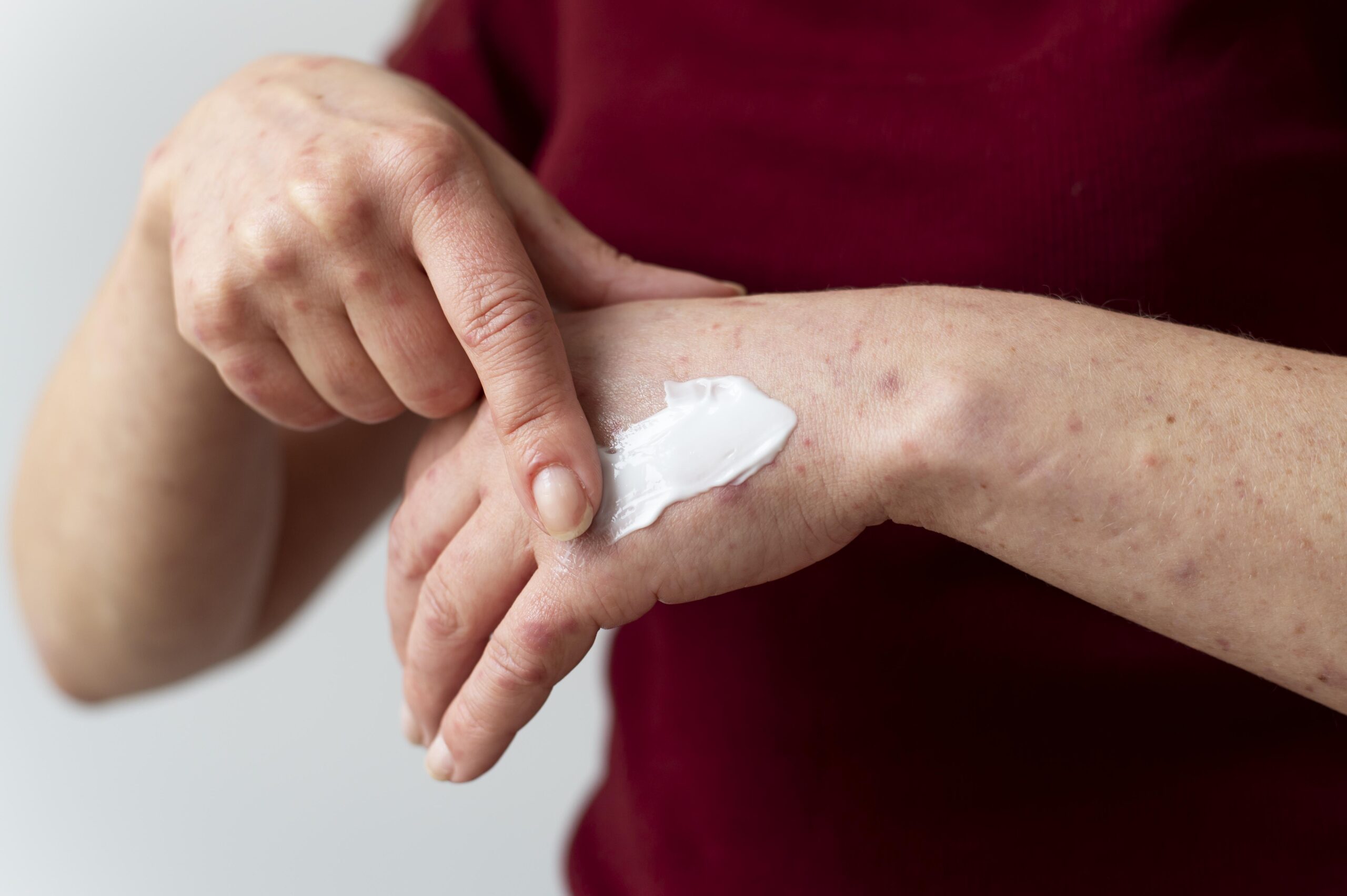 6 Tips for Psoriasis Skin Care