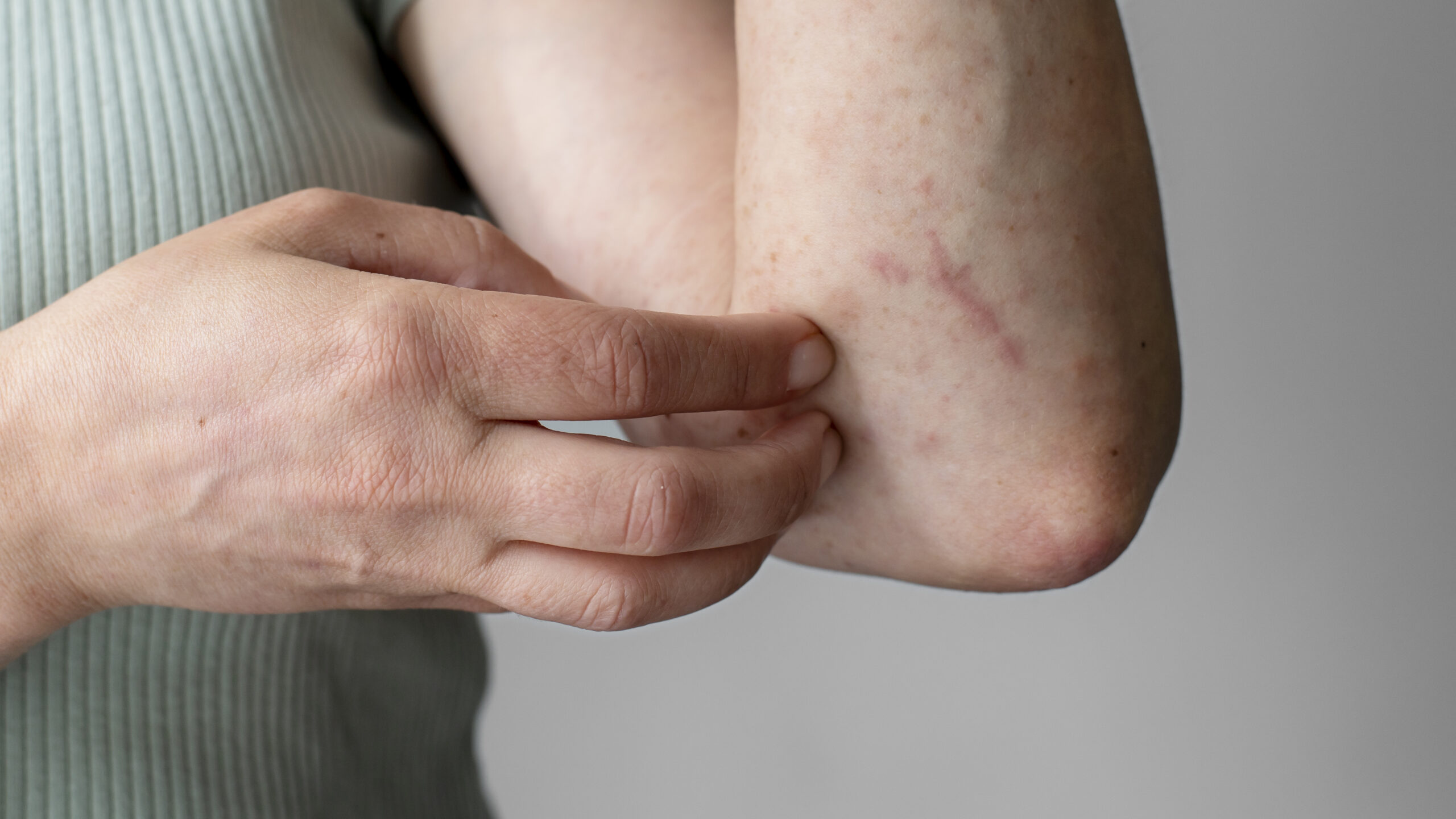 What is Pustular Psoriasis