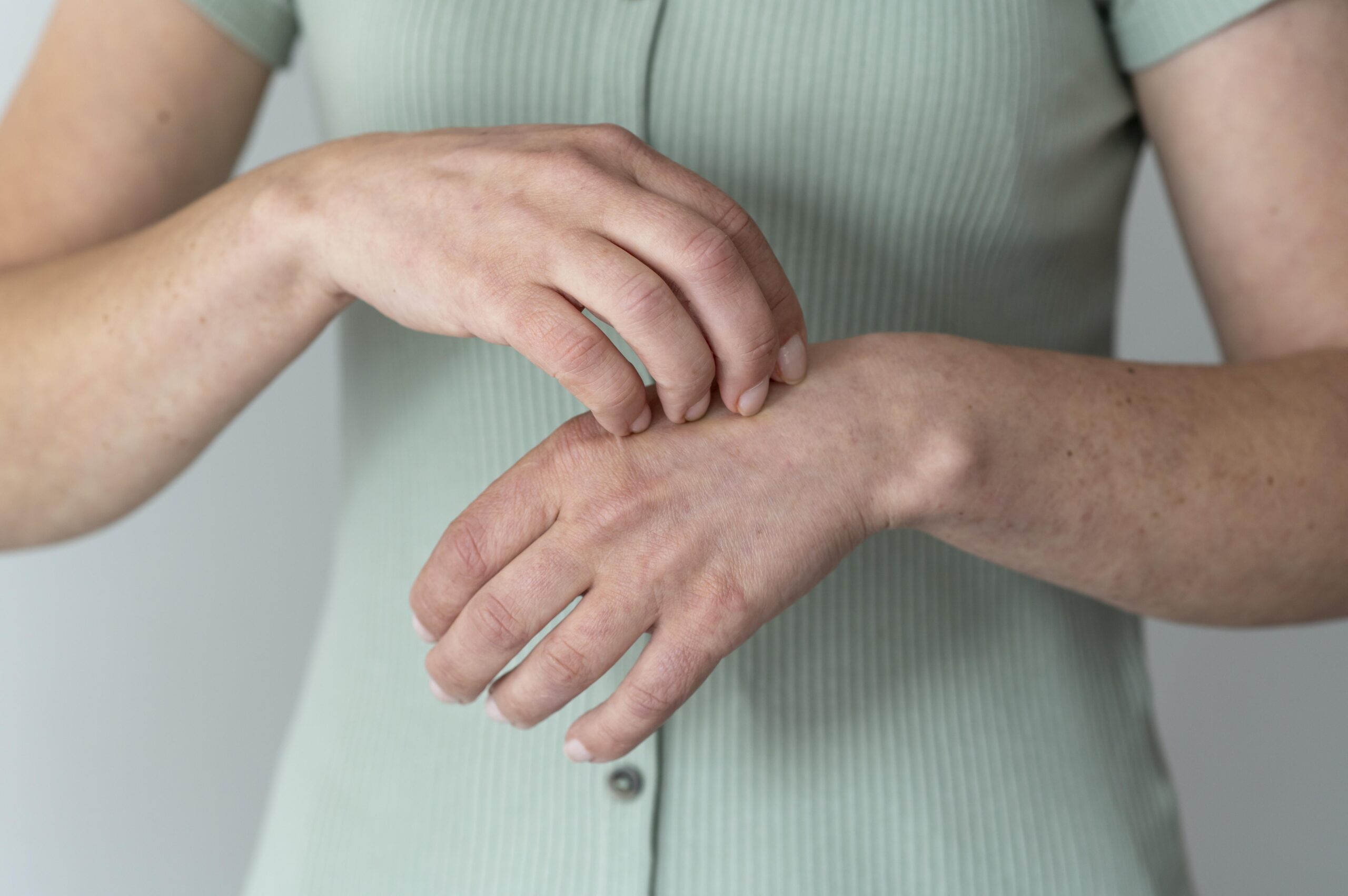 5 Ways to Avoid a Psoriatic Flare-up