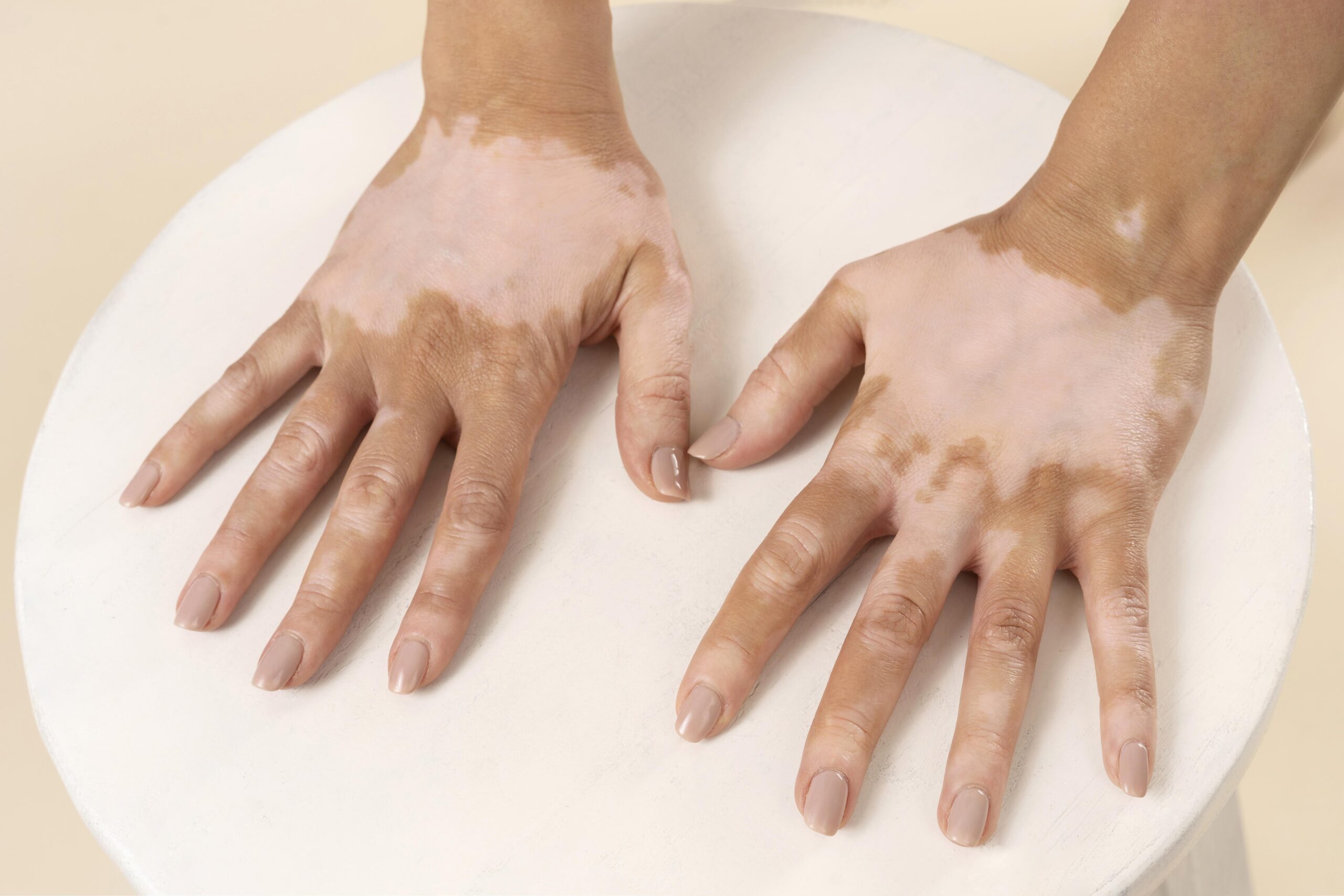 How To Treat Vitiligo Naturally