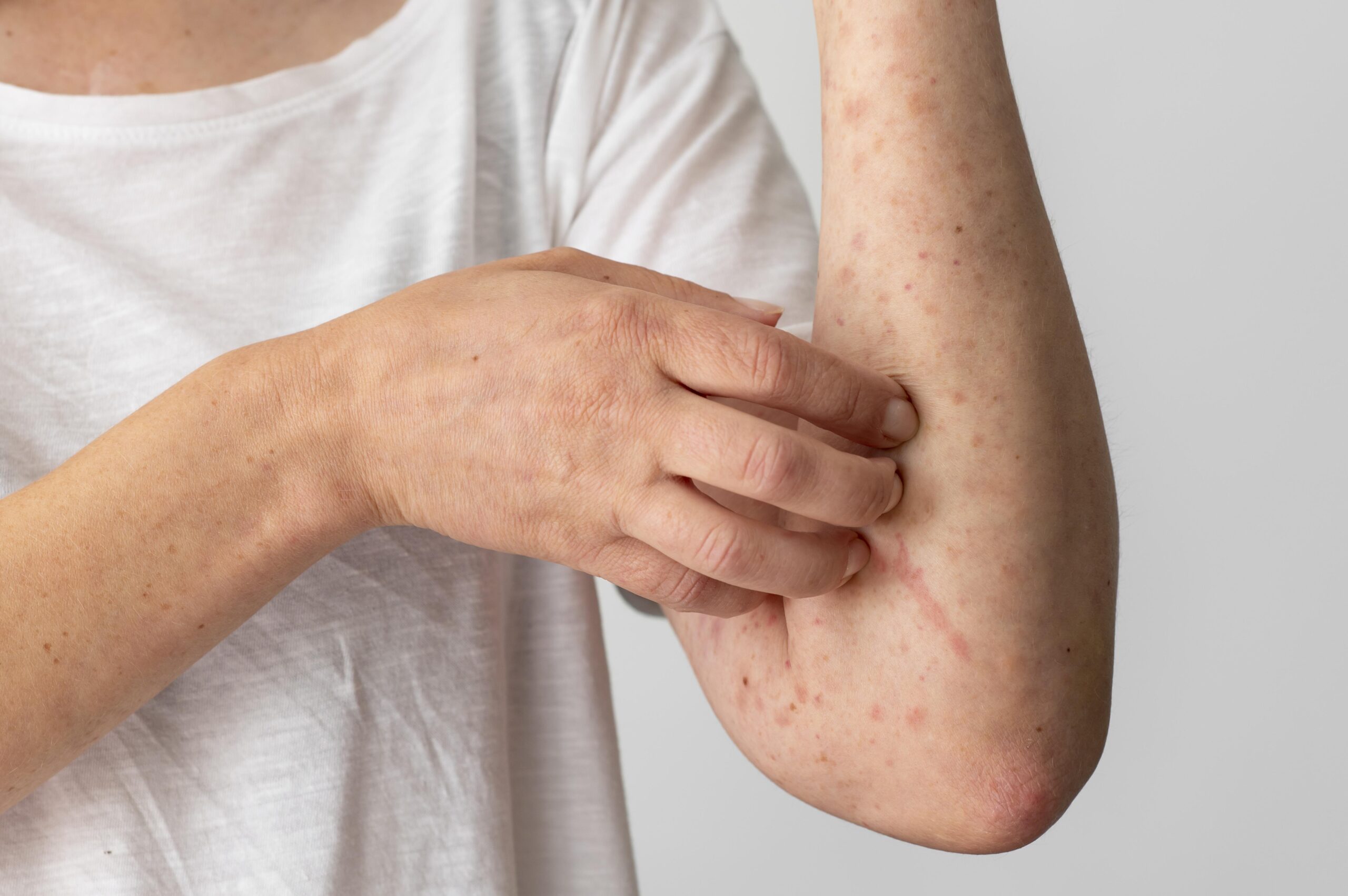 How To Heal Psoriasis Scars?