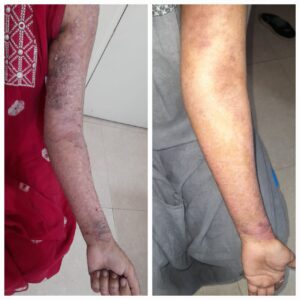 Plaque Psoriasis Treatment Results