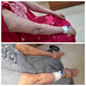 Plaque Psoriasis Treatment Results