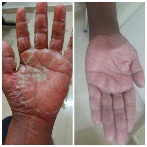 palmer psoriasis image