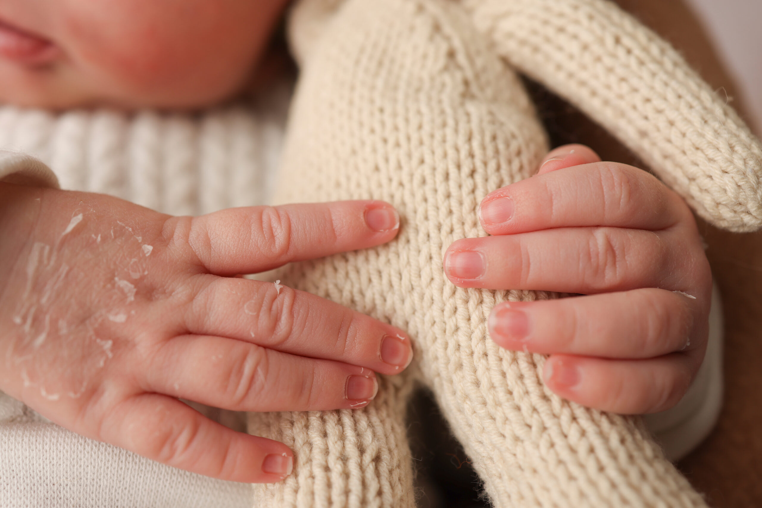 Understanding Psoriasis in Special Populations