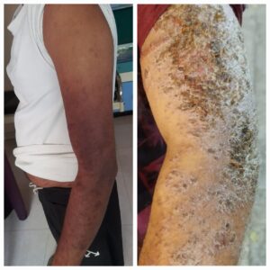 Patient treated from eczema by Dr. Ambalkar clinic