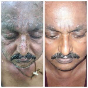 patient treated from ABCD Dermatitis by Dr. Ambalkar clinic