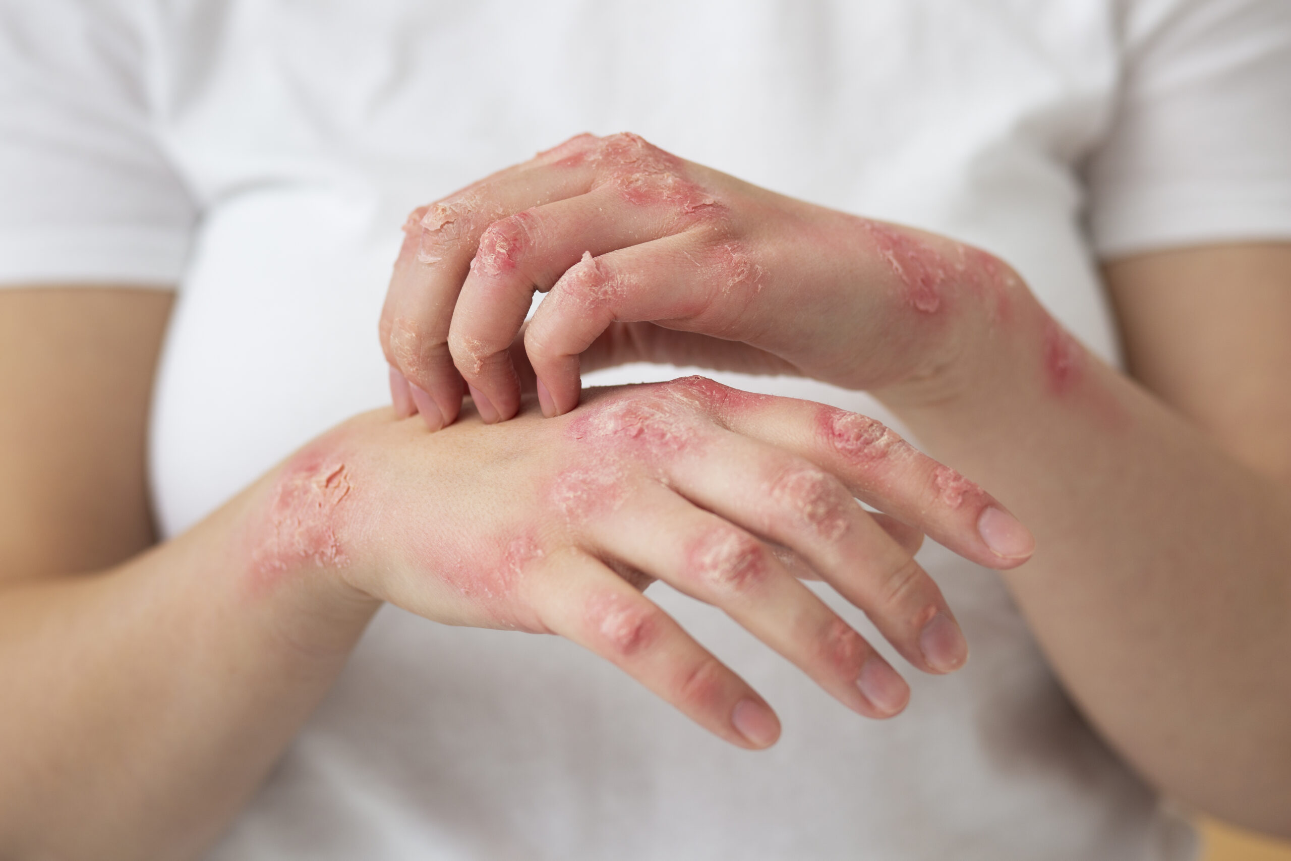 Ayurvedic Remedies for Eczema: An In-Depth Guide