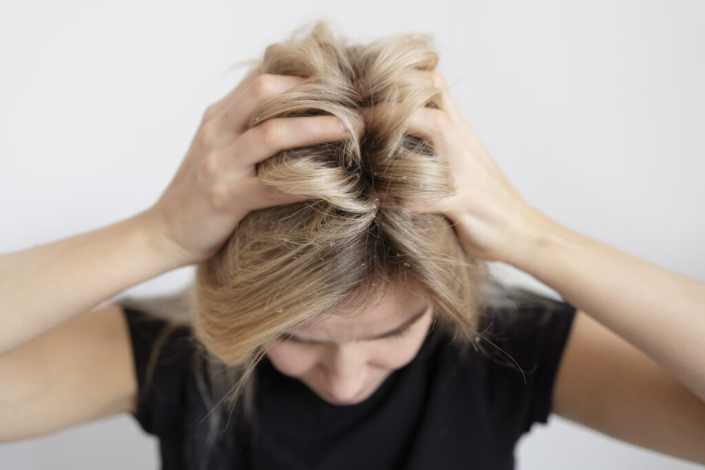 Ayurvedic Treatment for Scalp Psoriasis