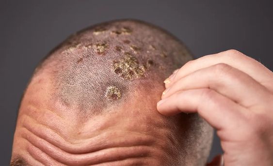 Ayurvedic Treatment for Scalp Psoriasis