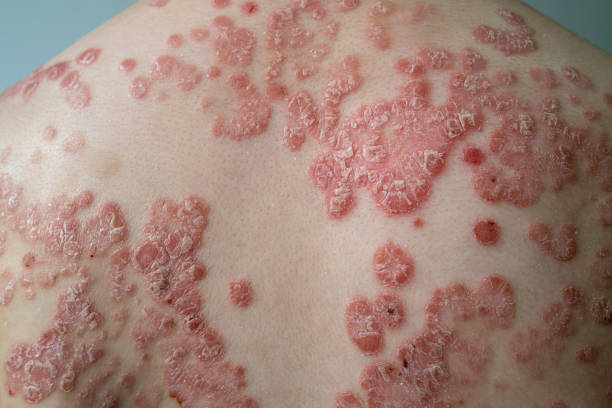 Guttate Psoriasis Treatment: A Short Introductory Guide