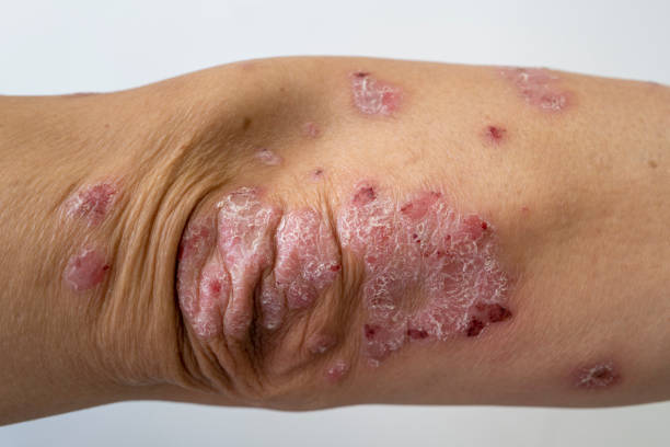 Natural Treatments for Inverse Psoriasis: Effective Ways to Soothe and Manage Symptoms