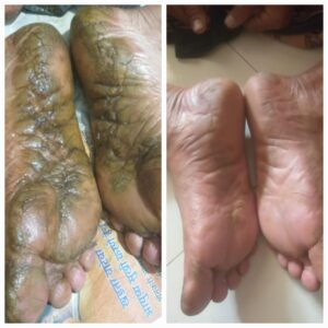 palmoplanter psoriasis on legs