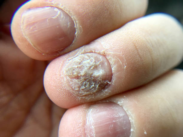 Big close up of fungus Infection on Nails Hand, Finger with onychomycosis, Fungal infection on nails.