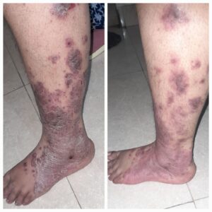 Plaque Psoriasis Treatment on ankle