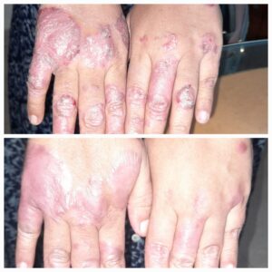 Plaque Psoriasis Treatment on back of palms