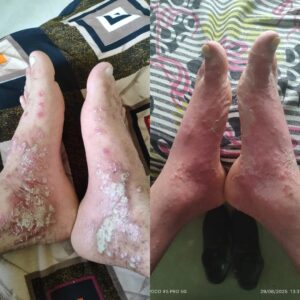 Pustular psoriasis treatment on ankles