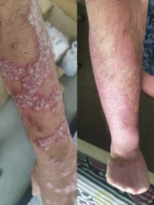 Pustular psoriasis treatment on hands
