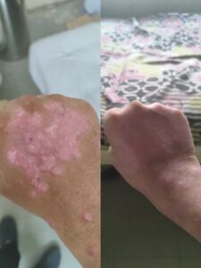 Pustular psoriasis treatment on palms