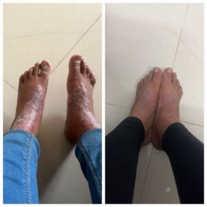 Wet Eczema treatment on legs