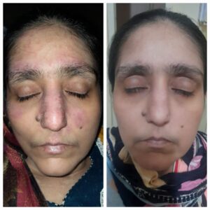Atopic Dermatitis ayurvedic treatment by Heal Psoriaisis