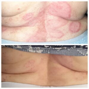 Plaque psoriasis ayurvedic treatment for back