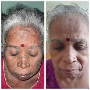 Pustular psoriasis ayurvedic treatment for face
