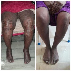 Pustular psoriasis ayurvedic treatment for legs