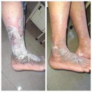 Pustular psoriasis treatment before and after of patient