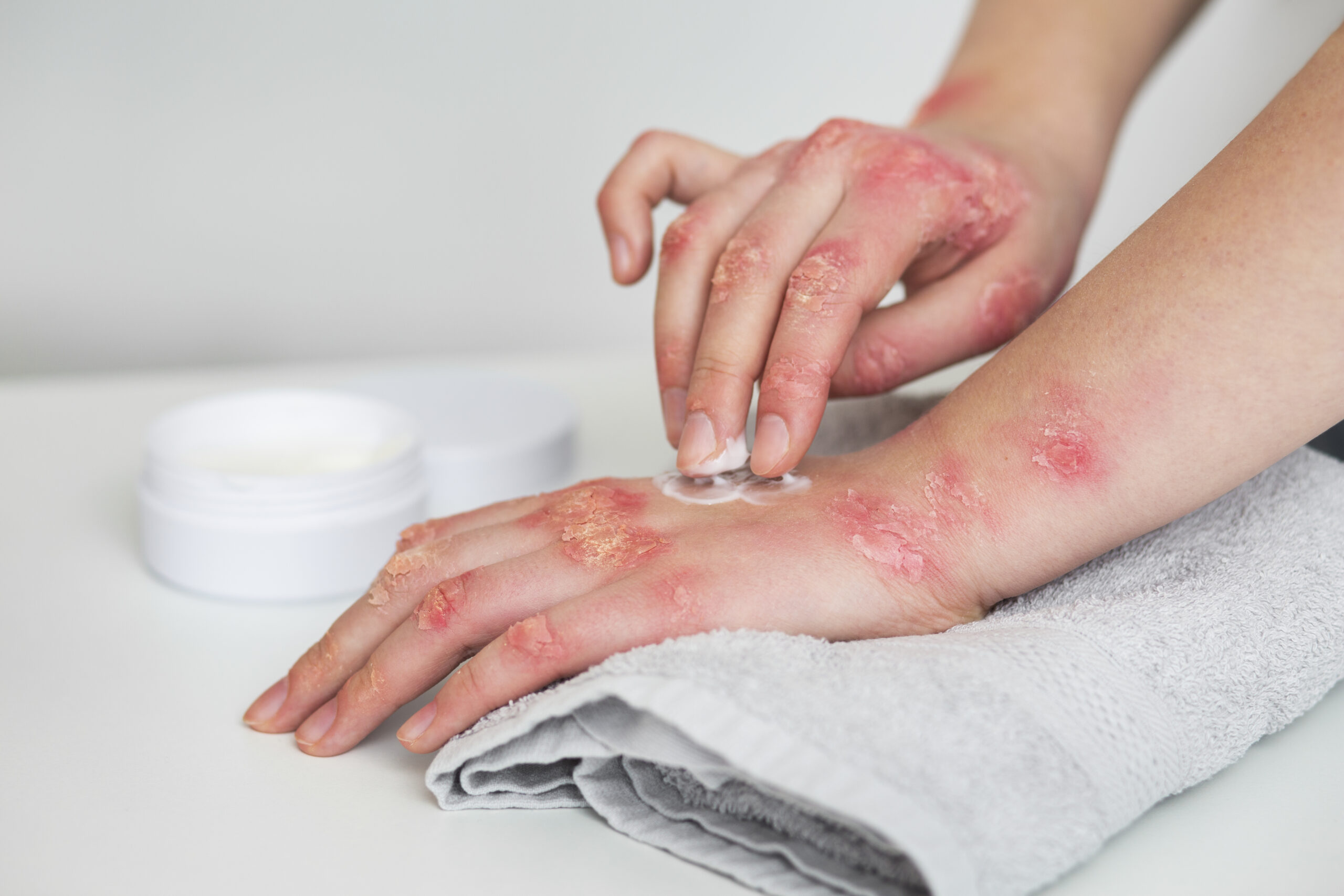Why Ayurvedic Psoriasis Treatment Is Safer and More Effective Long-Term