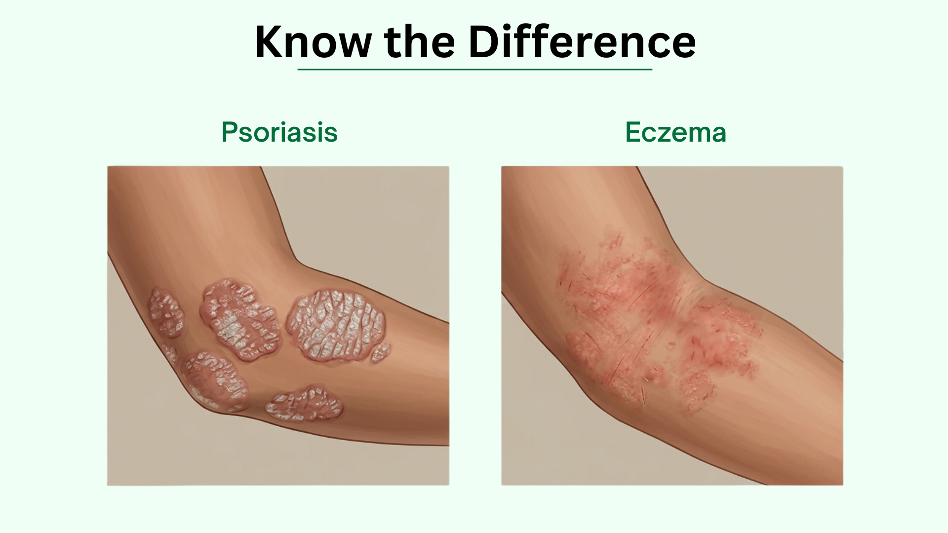 Difference Between Eczema And Psoriasis