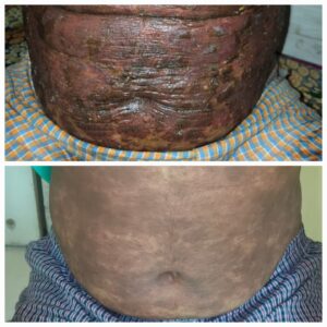 Successful Ayurvedic Treatment for Plaque Psoriasis on patient Rahul Ghag proof image 2