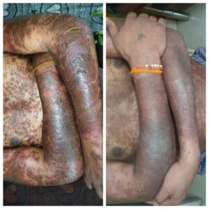 Successful Ayurvedic Treatment for Plaque Psoriasis on patient Rahul Ghag proof image 3