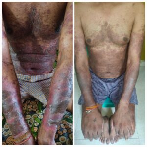 Successful Ayurvedic Treatment for Plaque Psoriasis on patient Rahul Ghag