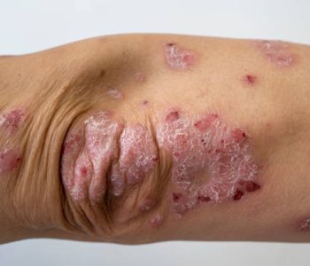 Image of an elbow infected with Inverse Psoriasis