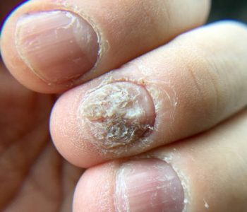 Big close up of fungus Infection on Nails Hand, Finger with onychomycosis, Fungal infection on nails.